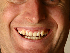 overbite teeth